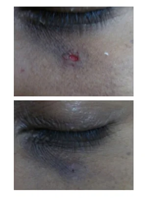 Biopsy