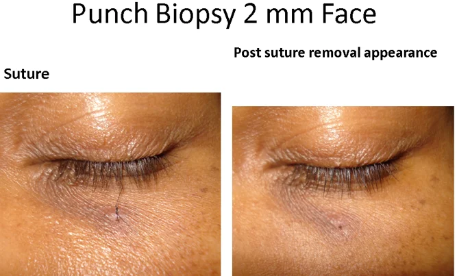 Biopsy