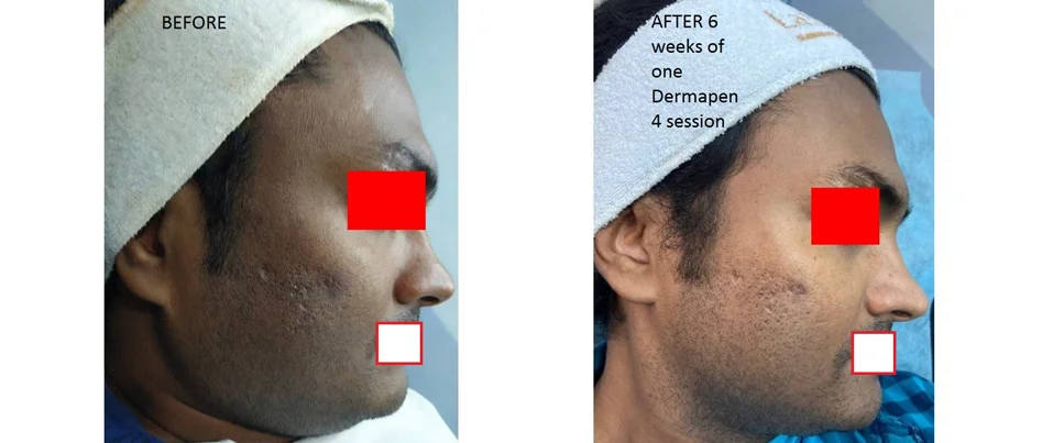 Derma Pen