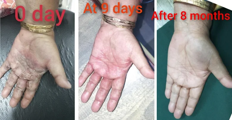 Eczema