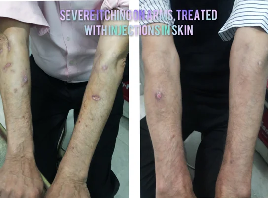 Eczema