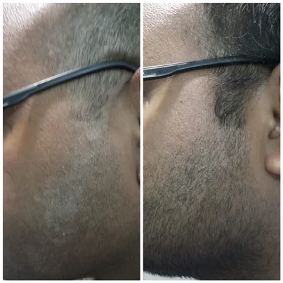 Eczema