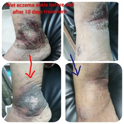 Eczema