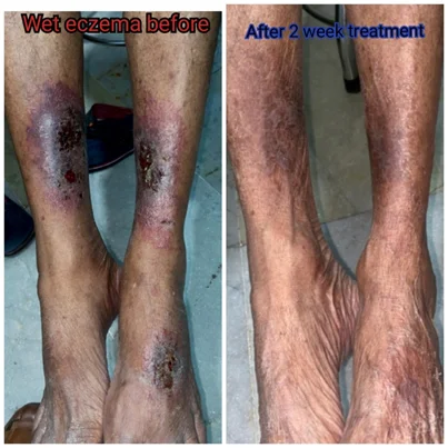 Eczema