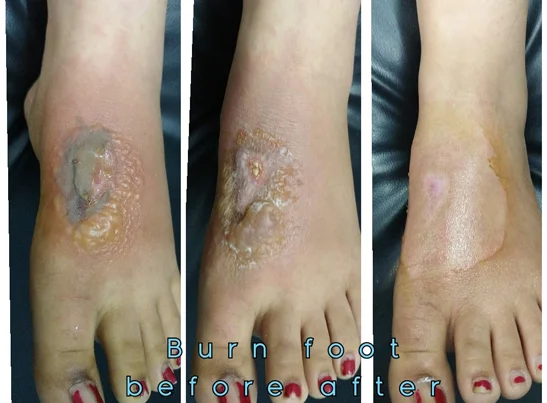 Eczema