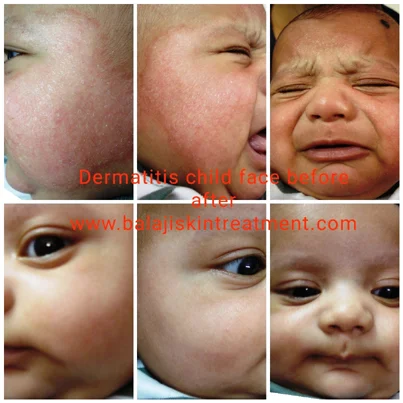 Eczema