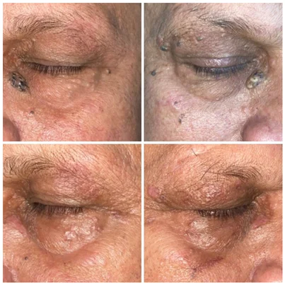Growths
