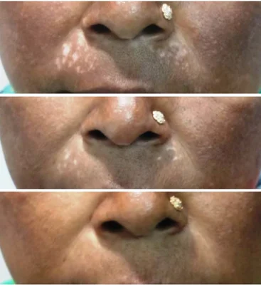 Hyperpigmentary Disorders