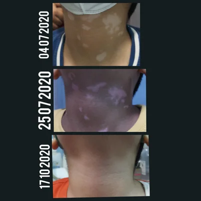 Hyperpigmentary Disorders