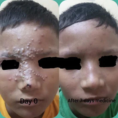 Infections