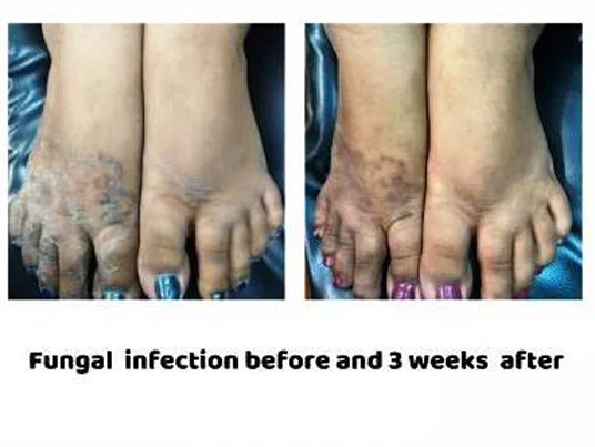 Infections