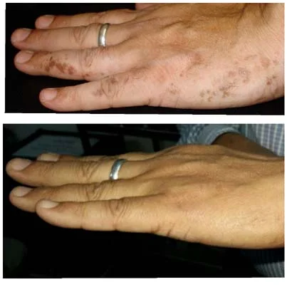 Keratinisation Disorders