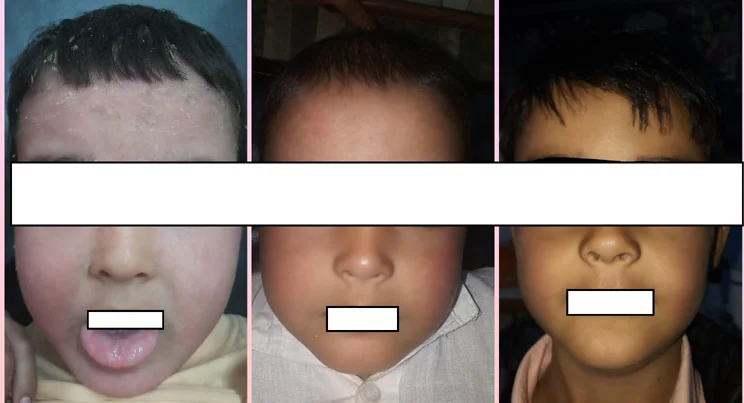 Keratinisation Disorders