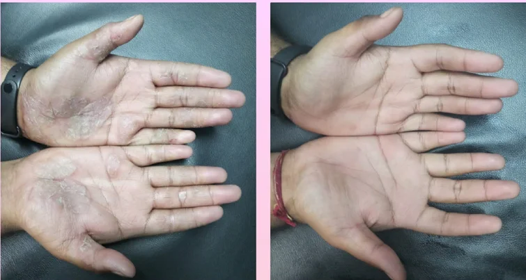 Keratinisation Disorders