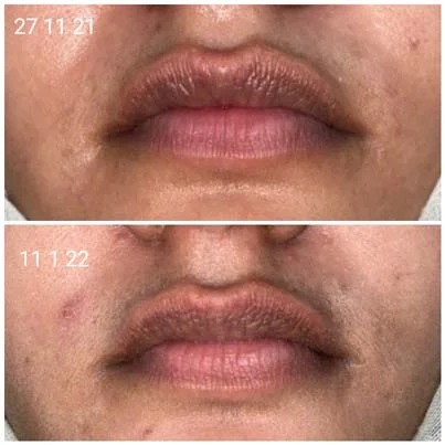 Lips