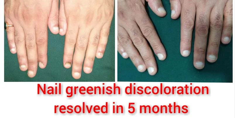 Nail
