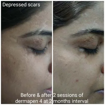 Scar