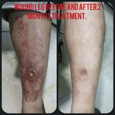 Wounds