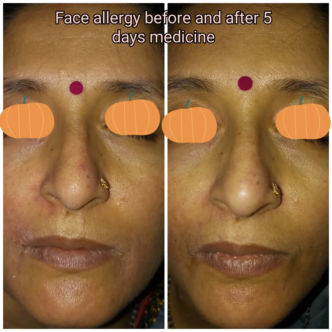 Eczema