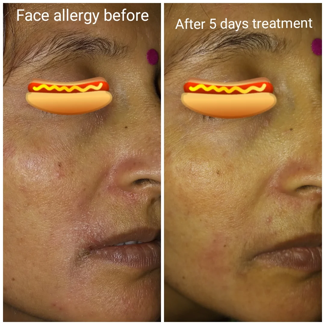 ECZEMA