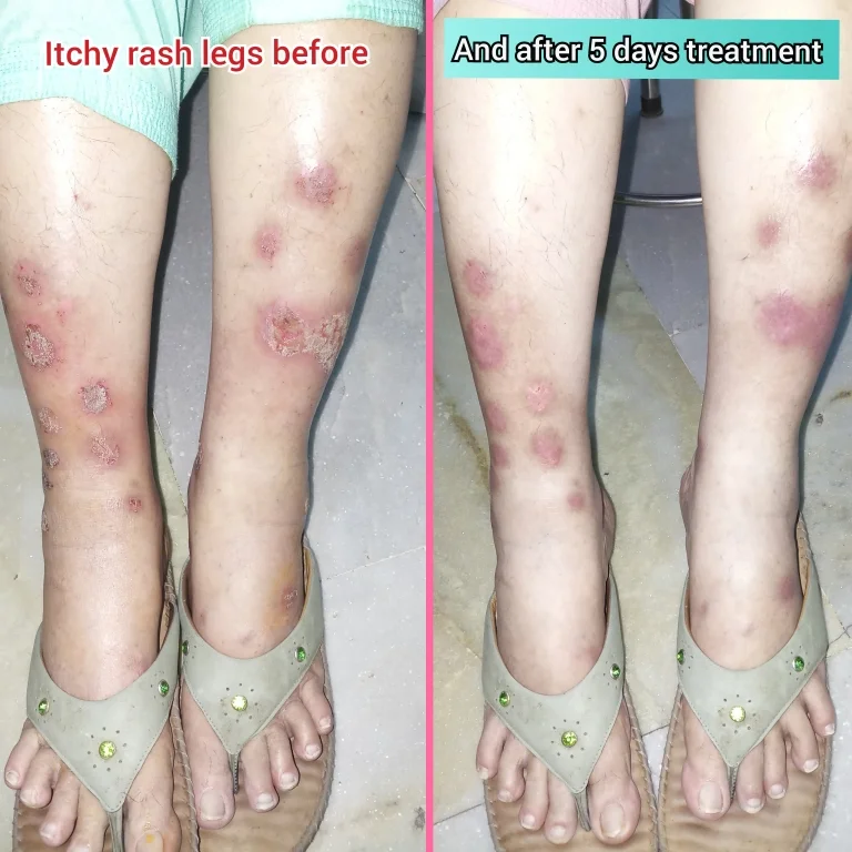 ECZEMA