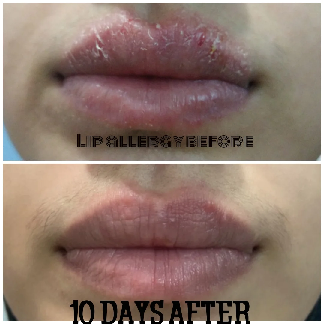 ECZEMA
