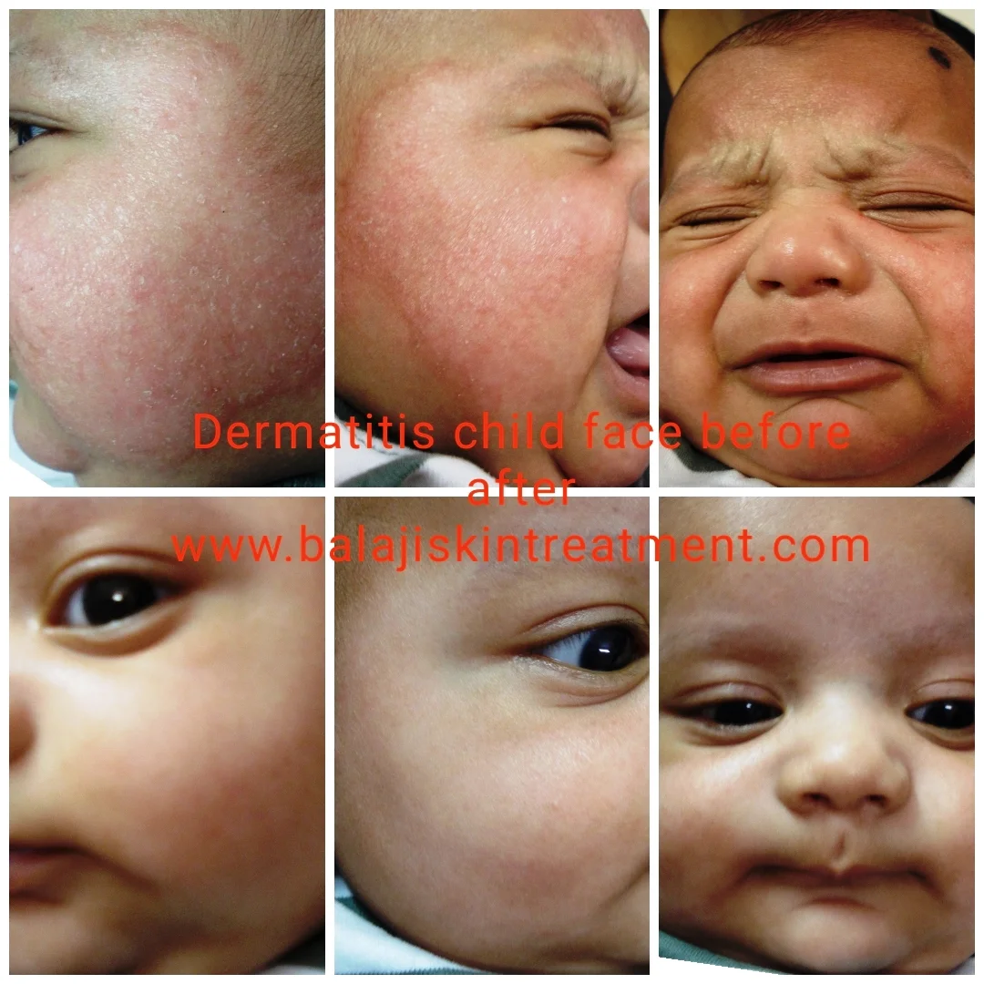 ECZEMA