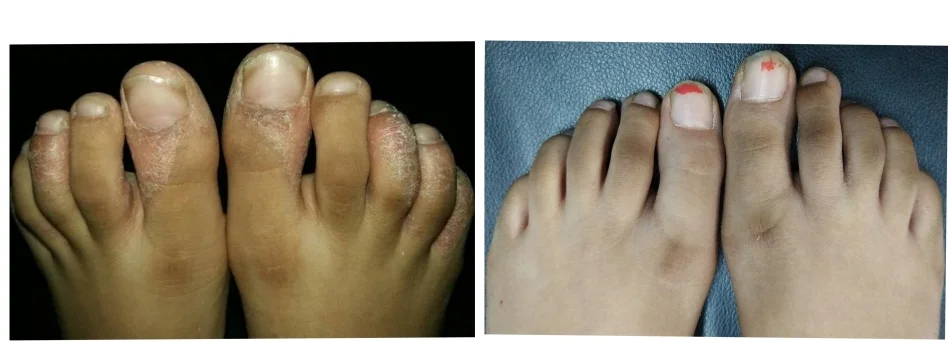 ECZEMA
