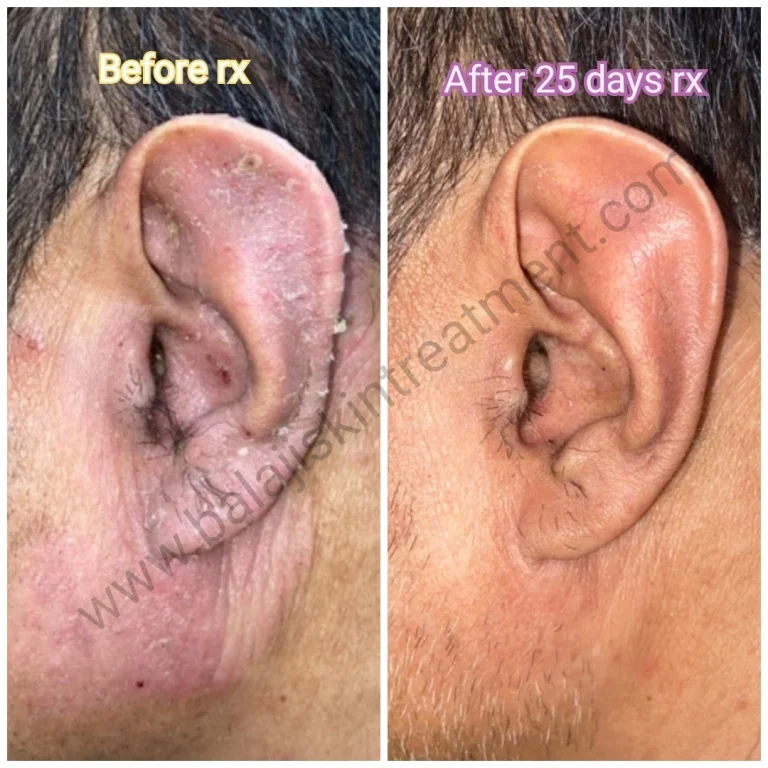 Eczema