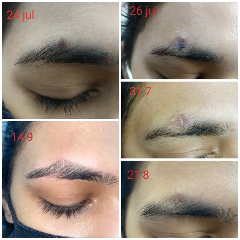 Mole Chin removal by Ellman RF