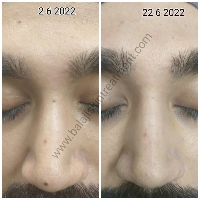 Mole Chin removal by Ellman RF
