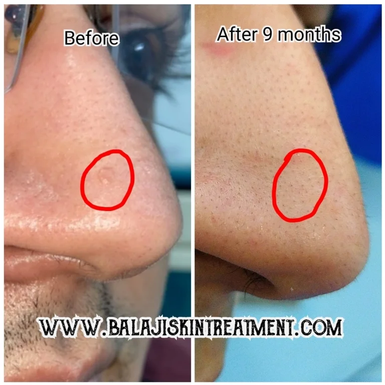 Mole Chin removal by Ellman RF