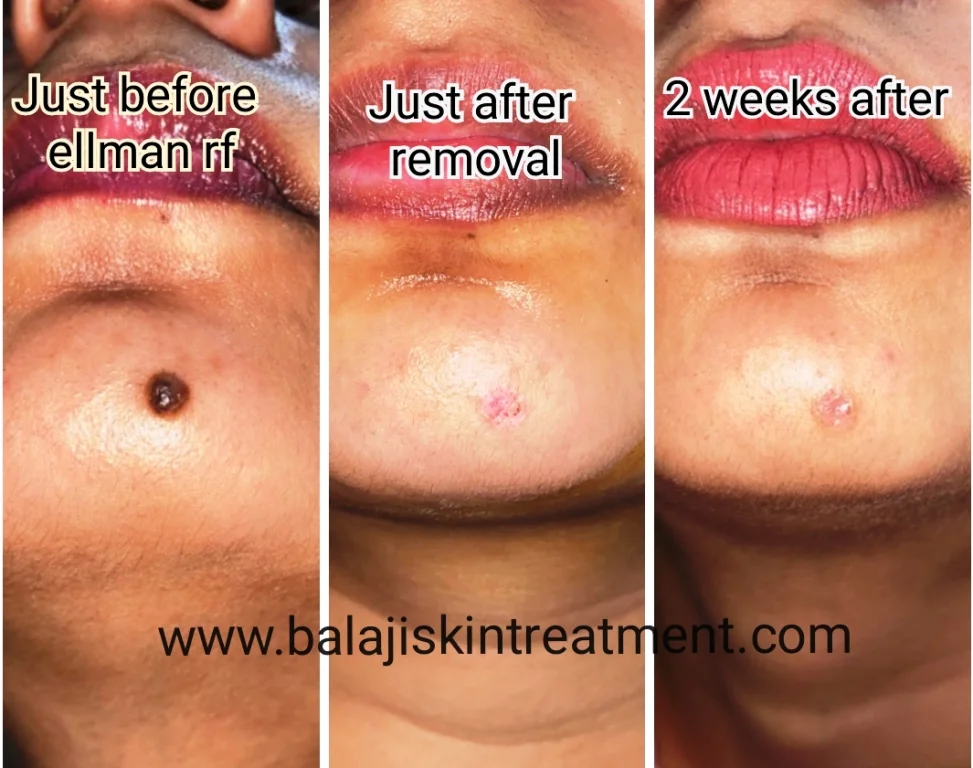 Mole Chin removal by Ellman RF