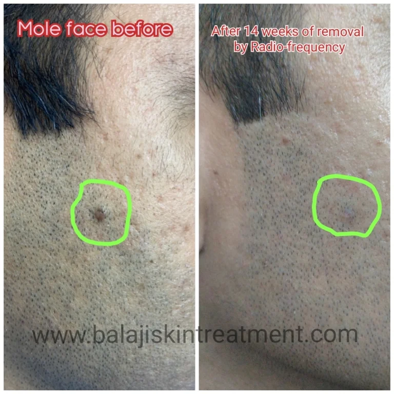 Mole removal by Ellman RF
