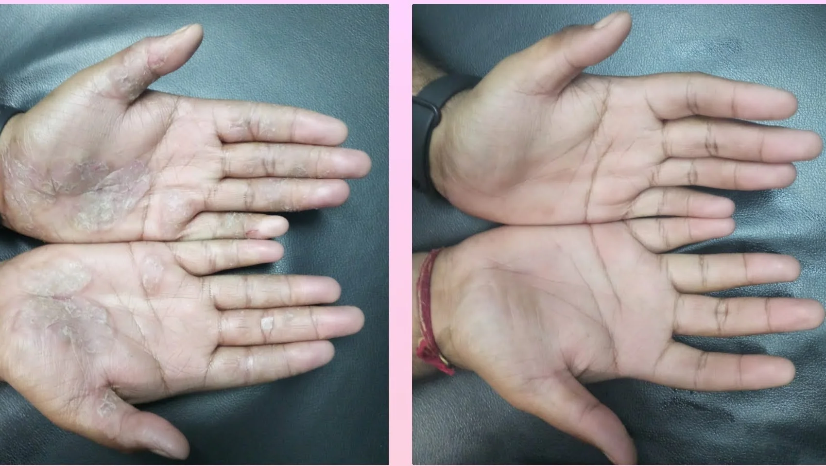 Eczema