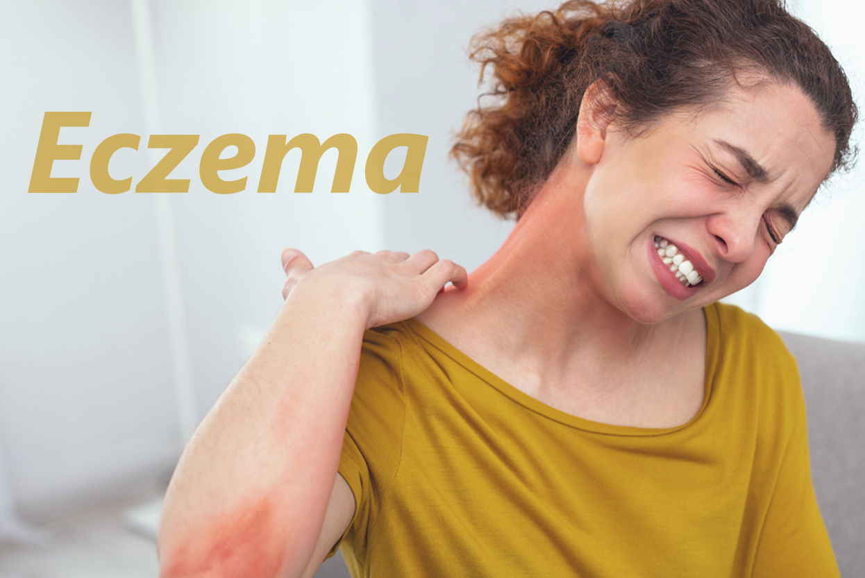 ECZEMA