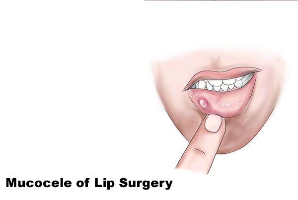 Mucocele of Lip Surgery