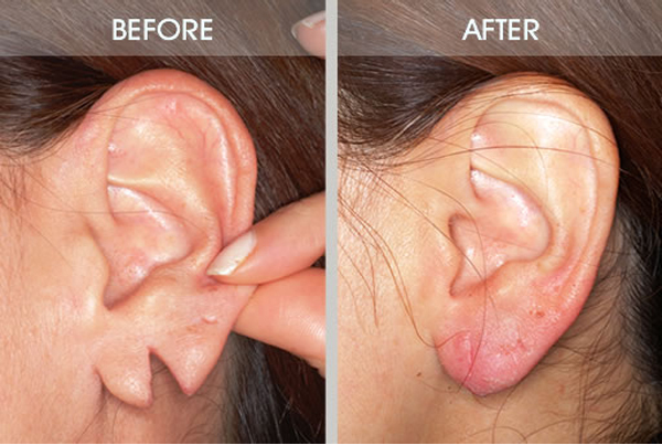 Torn Earlobe repair