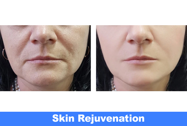 Skin Rejuvenation