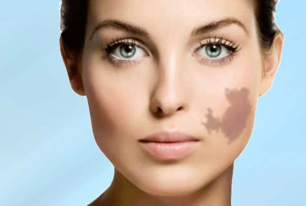 Chemical Peel For