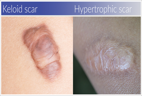 Keloid / Hypertrophic scar