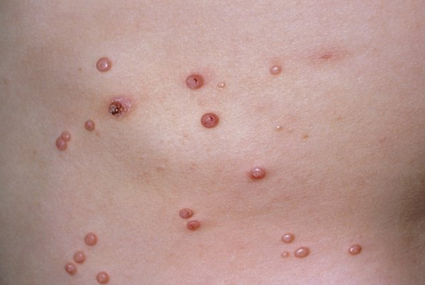 Molluscumcontagiosum