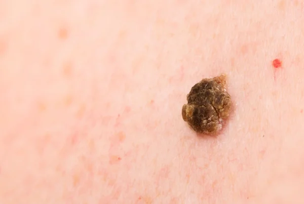 Seborrheic keratosis