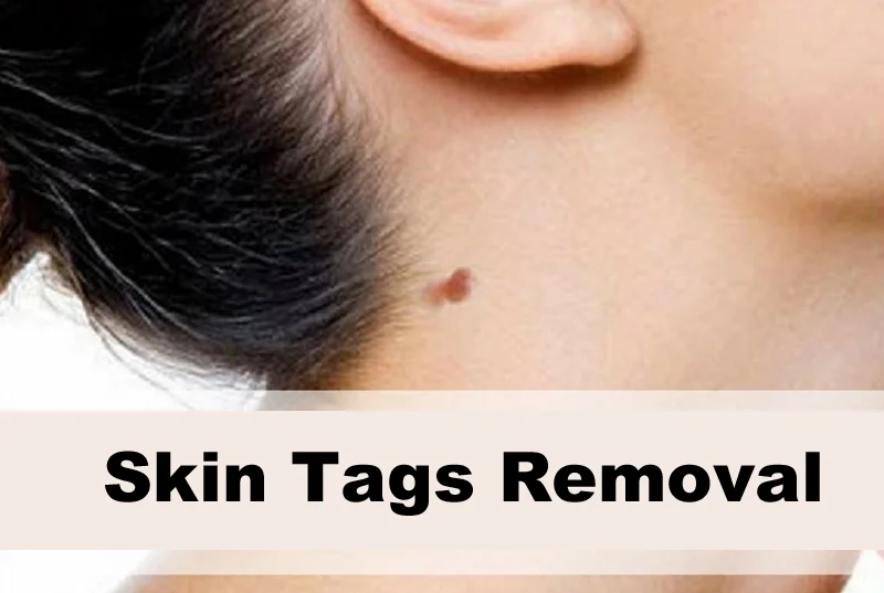 Skin  Tags