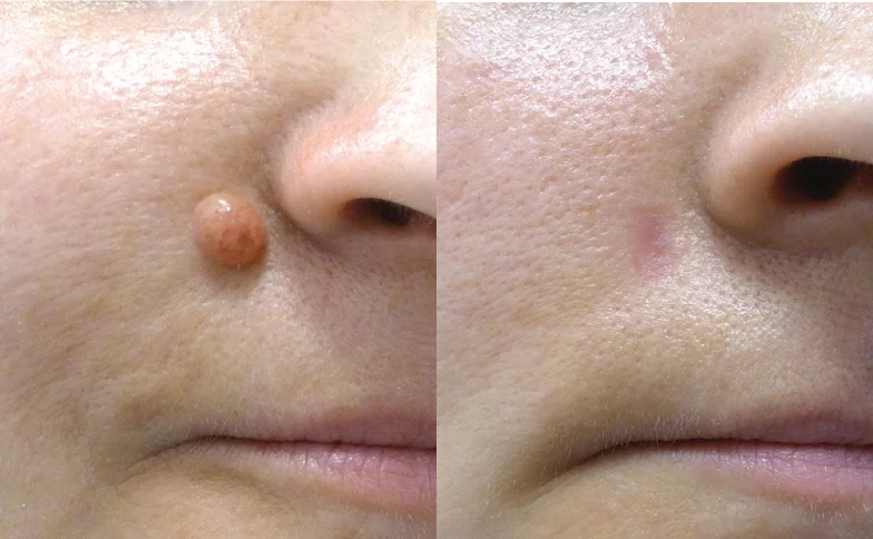 Moles