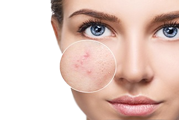 Acne Scars