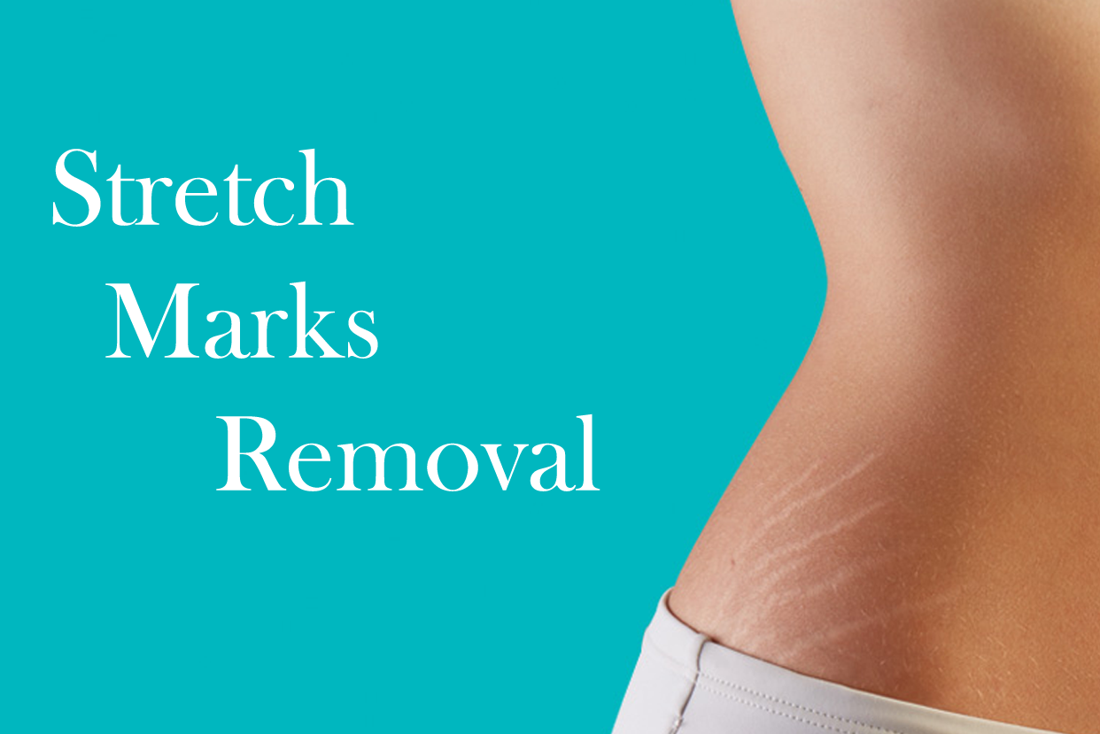 Stretch Markts