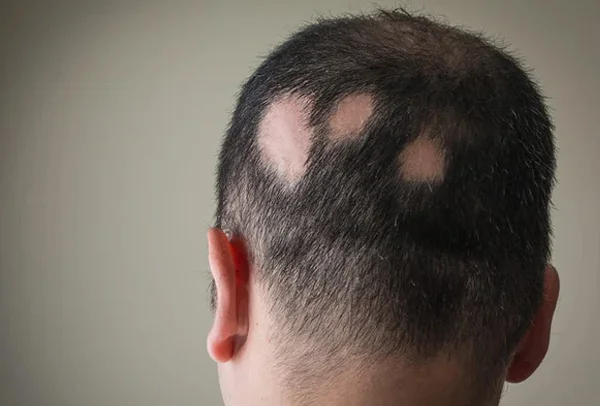 Alopecia