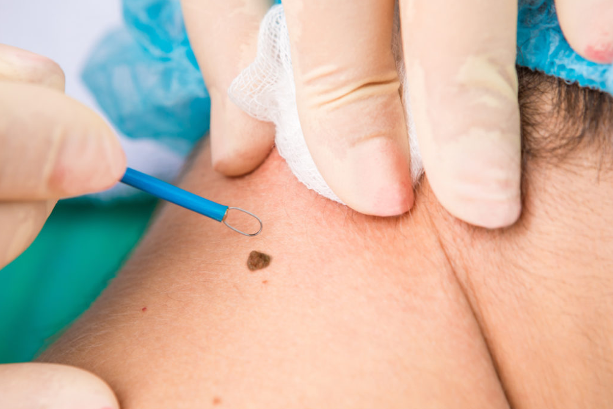 Warts