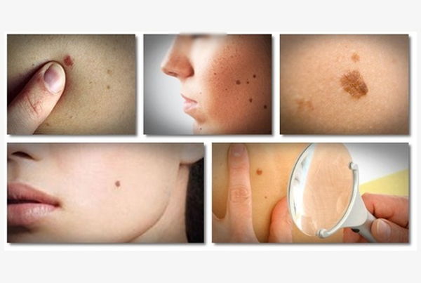 Warts